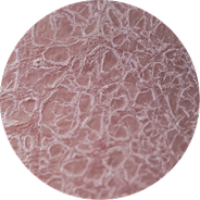 Ichthyosis