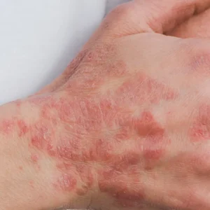 Atópiás dermatitisz
