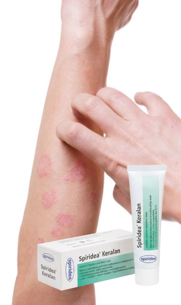 Atópiás dermatitisz