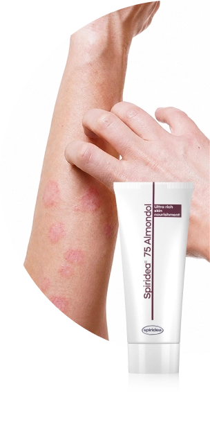 Atópiás dermatitisz